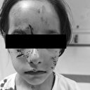 İstanbul’da başıboş köpek 6 yaşındaki kızın suratını parçaladı: Görüntüler silindi hayvan kaçırıldı