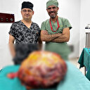 Karnından 26 kiloluk tümör çıktı: Böyle bir kitleyi literatürde hiç göremedim