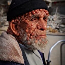 Gazze’de bombaların gölgesinde sabır ve direnişin öyküsü: Filistinli Abu Sabre cilt ve deri hastalığıyla pençeleşiyor