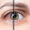 Uzmanından göz kuruluğu uyarısı: Bu belirtiler varsa mutlaka muayene olun