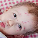 Öksürük, burun akıntısı, halsizlik ve gözde kızarıklık en belirgin belirtileridir: İşte Kızamık ile ilgili merak edilenler