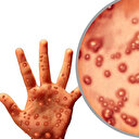 Sağlık Bakanlığı'ndan son dakika maymun çiçeği açıklaması: Türkiye'de vaka var mı?