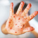 Maymun Çiçeği’nde paniğe gerek yok