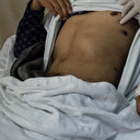 L'Australie comptabilise 93 nouveaux cas de Mpox