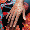 M çiçeği virüsü yayılıyor: Bir ülkeye daha sıçradı