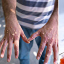 DSÖ'den kritik açıklama: M çiçeği virüsü yeni Kovid-19 mu?