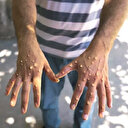 11 soruda M-Çiçeği