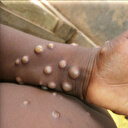 DSÖ maymun çiçeği ve COVID-19 arasındaki bulaşma farkına dikkati çekti