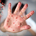 Vakalar artıyor: Filipinler'de M çiçeği vakalarının sayısı 3'e yükseldi