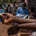 Les Philippines signalent deux nouveaux cas de Mpox