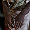 Nigéria: premier pays à recevoir 10 000 doses de vaccins contre le Mpox