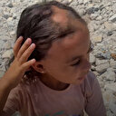 Gazzeli Lana'nın İsrail saldırılarında yaşadığı korku nedeniyle saçları döküldü: Savaştan önce saçlarım ipek gibi yumuşacıktı