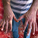 Nijerya'da M çiçeği alarmı: Vaka sayısı yükseliyor