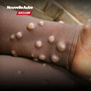 Mpox: État des lieux et réponses du Cameroun face à cette zoonose émergente