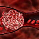 Düzenli egzersiz ve sağlıklı beslenme kan pıhtılaşması riskini azaltıyor