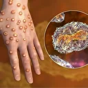 Pays-Bas: premier cas détecté d’une nouvelle variante du virus de la variole du singe