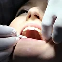 İlerleyen diş çürüğü sistemik hastalıkları tetikleyebilir