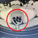 Kayseri'de midesinde 500 gram sentetik uyuşturucu bulunan zanlı yakalandı