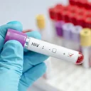 HIV kadınlarda 3 kat fazla görülüyor
