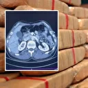 Ülkeye midelerinde uyuşturucu getiren şahıslar yakalandı