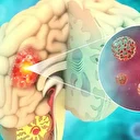 Beyin tümörlerinde baş ağrısı ve kusma kritik uyarı işareti olabilir