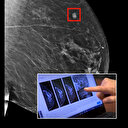 Yapay zeka kanser riskini tahmin edebiliyor