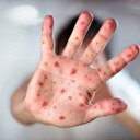 ABD'nin Teksas eyaletinde kızamık salgını: Vaka sayısı 223'e yükseldi