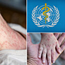 Avrupa ve Asya'da 'kızamık' alarmı: 27 yıl sonra pik yaptı