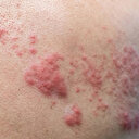 Vücudunuzda uyuyan virüs: Merak edilen zona hastalığı nedir?