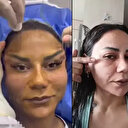 220 bin liraya estetik oldu hayatı kabusa döndü: Yüzüm dört ayda bu hale geldi