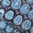 Beyin kanaması geçirdi: Kafatası parçasını midesinde taşıdı