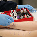 Alerjik rinitin astıma ilerleme riski nedeniyle erken tanı ve tedavi önemli