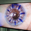 Gözler yeniden umutla açıldı: Samsun'da 83 yaşındaki hastaya kornea nakledildi