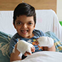 Doktorlar bile hastalığını adını bilmiyordu: 4 yaşındaki Umut tedavi oldu, 10 parmağı açıldı