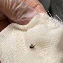 Eskişehir'de kene paniği hastanede bitti: Zararsız bir şekilde çıkarıldı