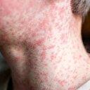 Dünyanın en bulaşıcı hastalığı 10 kişiden 9'unu enfekte ediyor: 'Kalabalıklardan uzak durun' uyarısı