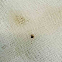 Halsizlik yüzünden hastaneye başvuran kadının karnına yapışmış kene bulundu