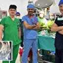 Doktorlar bile inanamadı: Hastanın karaciğerinden 90 santimetrelik kedi-köpek kisti çıkarıldı