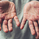 M çiçeği vakalarında artış görüldü: Hem hayvanlardan hem de insanlardan bulaşıyor