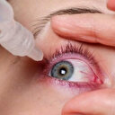 Uzmanı uyardı: Kuru göz hastalığında steroid kullanımına dikkat