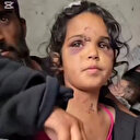 Dürzi isyancılar Süveyda'da çocuklara saldırdı: Yüzü gözü moraran küçük Revan yaşadıklarını anlattı