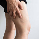 Uzmanından kritik uyarı: Yaz aylarında artan varis şikayetleri ihmal edilmemeli