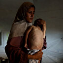 Des organisations humanitaires alertent sur la malnutrition infantile à Gaza