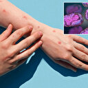 Gana'da M çiçeği virüsü kaynaklı ilk ölüm 