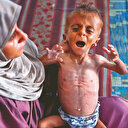 40 bin bebek açlıktan ölüyor