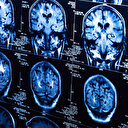 Covid-19 beyni yaşlandırdı: Bilim adamları 'cesaret verici' deyip açıkladı