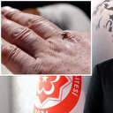 Erken teşhis ve doğru müdahaleyle KKKA'dan kurtulmak mümkün