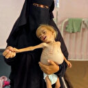 Gazzeli küçük Şam açlık sebebiyle ölümle pençeleşiyor