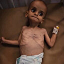 Gazzeli bebekler yetersiz beslenme nedeniyle ölümün eşiğinde