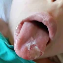 Nevşehir’de 5 yaşındaki çocuğun ameliyatta dili ve dudağı yandı